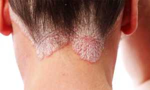 Почему не берут в армию с псориазом? Узнайте причины и последствия.