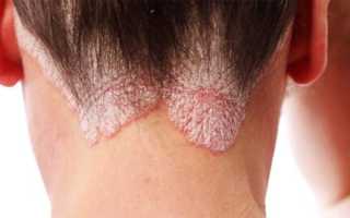 Почему не берут в армию с псориазом? Узнайте причины и последствия.