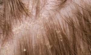 Методы лечения и профилактика жирной себореи кожи головы