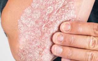 Последствия и опасности кожного заболевания псориаз для здоровья