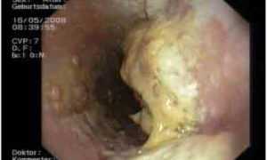 Какие бывают виды инфекционного заболевания — молочницы и их особенности