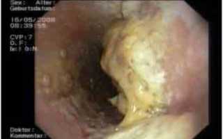 Какие бывают виды инфекционного заболевания — молочницы и их особенности