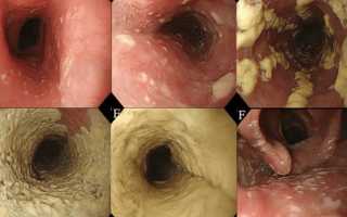 Грибковое заболевание Кандидоз желудочно-кишечного тракта: причины и лечение