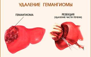 Гемангиома печени причины возникновения у взрослых