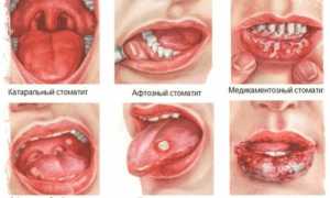 Лечения заболевания ротовой полости Кандидозный стоматит: методы и рекомендации