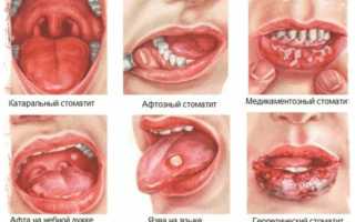 Лечения заболевания ротовой полости Кандидозный стоматит: методы и рекомендации