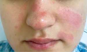 Особенности диагностики и лечения псориаза на лице для пациентов