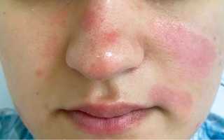Особенности диагностики и лечения псориаза на лице для пациентов