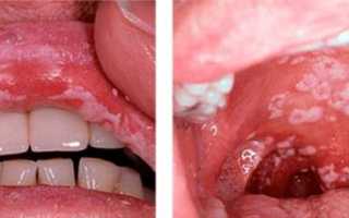 Симптомы и методы борьбы с острым кандидозом у взрослых