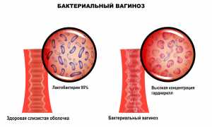 Причины возникновения бактериального кандидоза и методы лечения заболевания