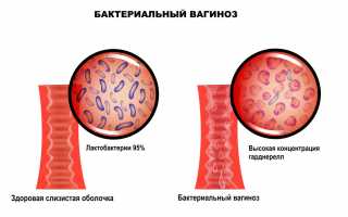 Причины возникновения бактериального кандидоза и методы лечения заболевания