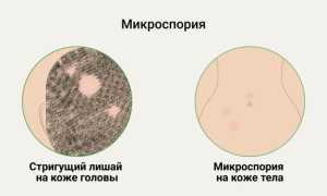 Симптомы и причины появления грибка на спине: важные аспекты здоровья