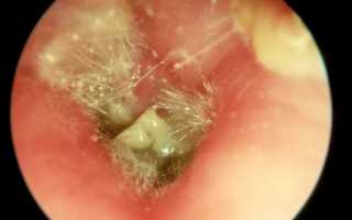 Эффективные способы лечения грибковой инфекции в ушах: советы и рекомендации