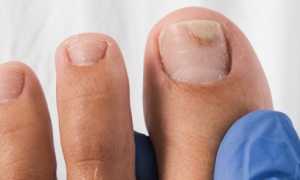 Рекомендации по способам размягчения ногтей на ногах при грибке для здоровья