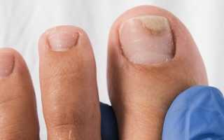 Рекомендации по способам размягчения ногтей на ногах при грибке для здоровья