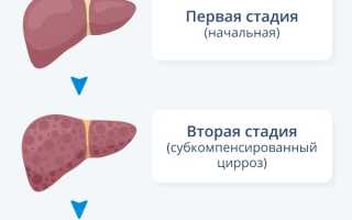 Цирроз печени сколько живут