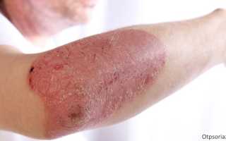 Псориаз – код по МКБ 10