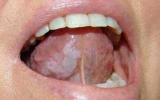 Эффективное антимикотическое средство — итраконазол для лечения грибковых инфекций