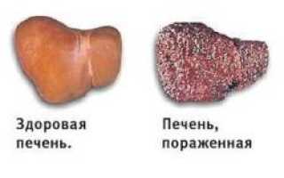Ласковый убийца гепатит с