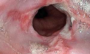 Что такое микоз пищевода и как его лечить: причины и симптомы