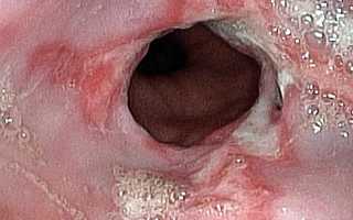 Что такое микоз пищевода и как его лечить: причины и симптомы