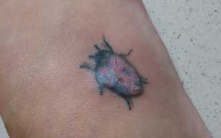 Можно ли набивать татуировку при псориазе? Важные аспекты