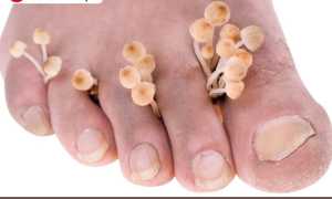 Что такое глубокие микозы и как их предотвратить: полезные советы