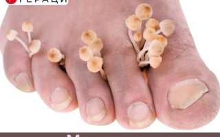 Что такое глубокие микозы и как их предотвратить: полезные советы