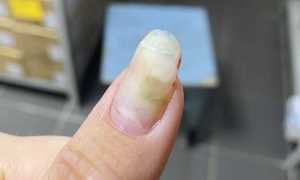 Как обезопасить себя от грибка ногтей после наращивания ногтей