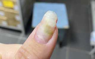 Как обезопасить себя от грибка ногтей после наращивания ногтей