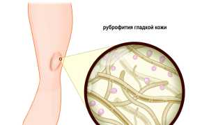 Общие сведения о дерматофитии кистей рук и ее лечении