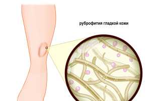Общие сведения о дерматофитии кистей рук и ее лечении