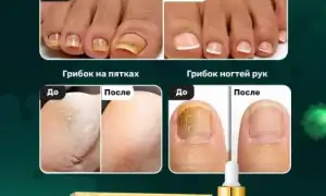 Препараты и процедуры для профилактики грибка ногтей на ногах: советы и рекомендации