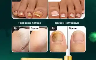 Препараты и процедуры для профилактики грибка ногтей на ногах: советы и рекомендации
