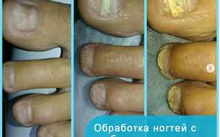 Способы удаления пораженного грибком ногтя в домашних условиях