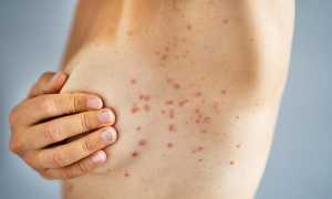 Симптомы, диагностика и способы лечения каплевидного псориаза у пациентов