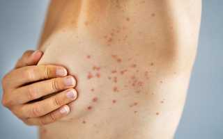 Симптомы, диагностика и способы лечения каплевидного псориаза у пациентов