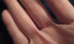 Как лечить грибок между пальцами рук — полезные советы для здоровья