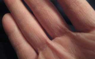 Как лечить грибок между пальцами рук — полезные советы для здоровья