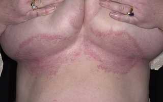 Почему появляется грибок под грудью у женщин: причины и последствия