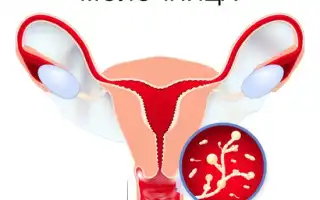 Может ли температура быть симптомом молочницы у женщин?