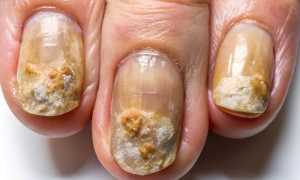 Как лечить запущенную форму грибка ногтя? Полезные советы и рекомендации