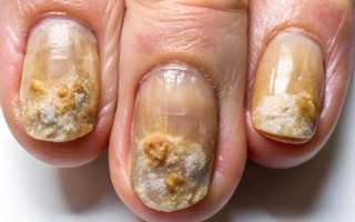 Как лечить запущенную форму грибка ногтя? Полезные советы и рекомендации