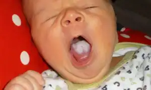 Методы лечения молочницы у детей: советы и рекомендации