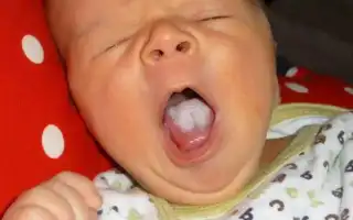 Методы лечения молочницы у детей: советы и рекомендации