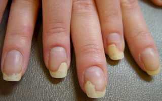 Как выглядит грибок на ногтях рук и как правильно его лечить: советы и рекомендации