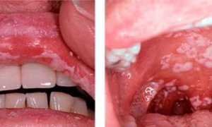 Поражение слизистой горла молочницей: причины и лечение