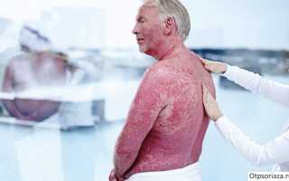 Эффективные лосьоны от псориаза