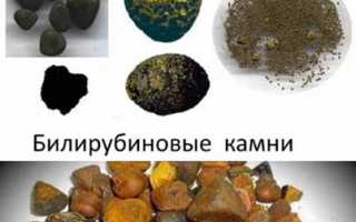 Виды камней в желчном пузыре