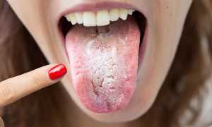 Поражение губ человека инфекционным заболеванием кандидоз: причины и лечение